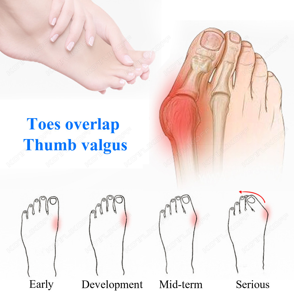 Toe Protective Toes Separator  – Toe Separator Silicon recenzja i cena