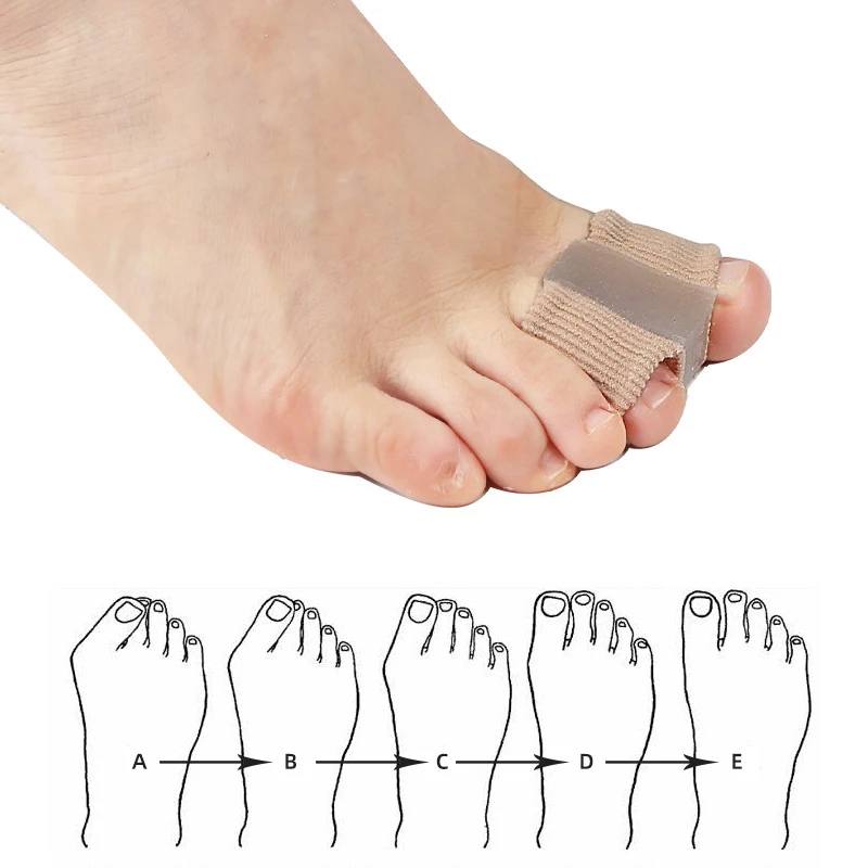New Toe Separator Hallux Valgu – Toe Separator Silicon recenzja i cena